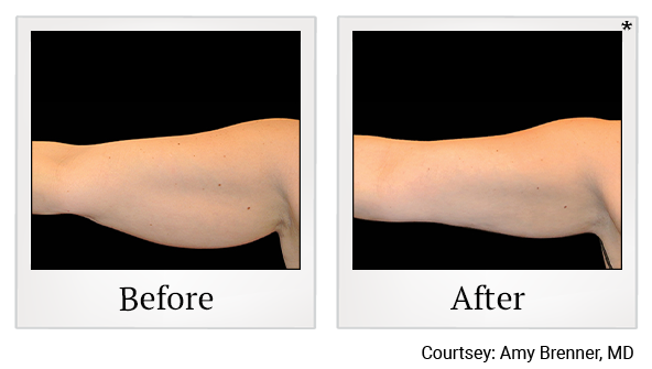 Before and After Photo 5 of Coolsculpting® treatment at SF Bay Cosmetic Surgery Medical Group in San Ramon