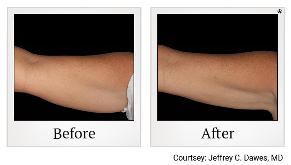 Before and After Photo 7 of Coolsculpting® treatment at SF Bay Cosmetic Surgery Medical Group in San Ramon