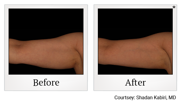 Before and After Photo 8 of Coolsculpting® treatment at SF Bay Cosmetic Surgery Medical Group in San Ramon