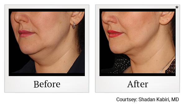Before and After Photo 6 of Coolsculpting® treatment at SF Bay Cosmetic Surgery Medical Group in San Ramon, Pleasanton, San Jose, and Oakland