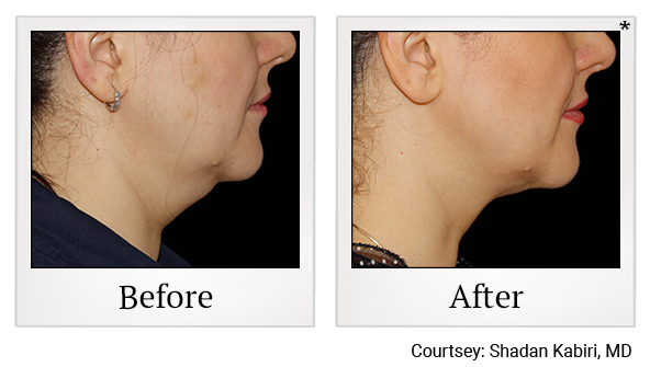 Before and After Photo 2 of Coolsculpting® treatment at SF Bay Cosmetic Surgery Medical Group in San Ramon