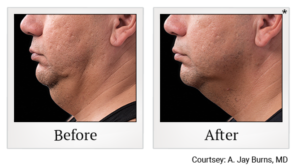 Before and After Photo 6 of Coolsculpting® treatment at SF Bay Cosmetic Surgery Medical Group in San Ramon
