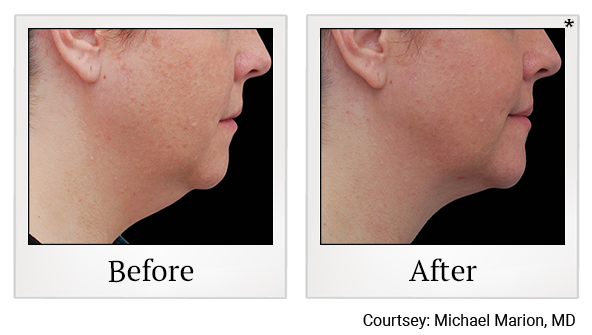 Before and After Photo 9 of Coolsculpting® treatment at SF Bay Cosmetic Surgery Medical Group in San Ramon