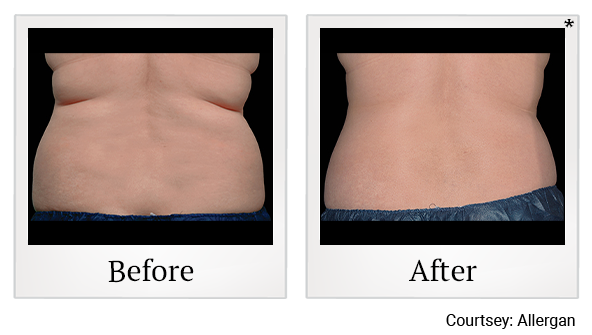 Before and After Photo 1 of Coolsculpting® treatment at SF Bay Cosmetic Surgery Medical Group in San Ramon