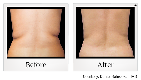 Before and After Photo 13 of Coolsculpting® treatment at SF Bay Cosmetic Surgery Medical Group in San Ramon