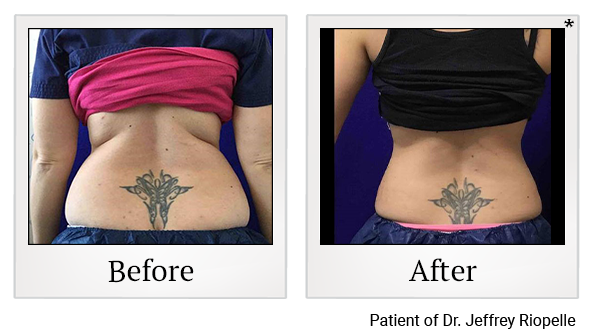 Before and After Photo 3 of Coolsculpting® treatment at SF Bay Cosmetic Surgery Medical Group in San Ramon, Pleasanton, San Jose, and Oakland