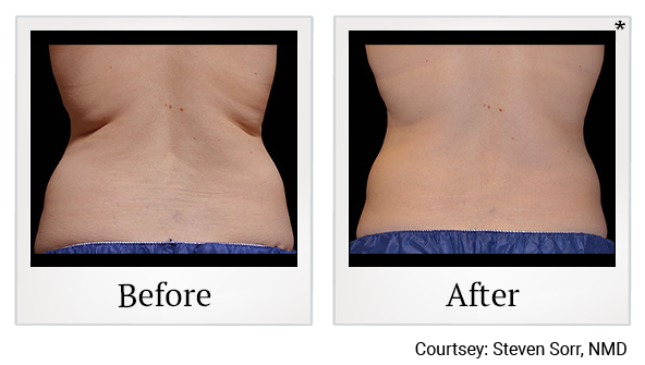 Before and After Photo 5 of Coolsculpting® treatment at SF Bay Cosmetic Surgery Medical Group in San Ramon