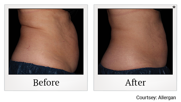 Before and After Photo 10 of Coolsculpting® treatment at SF Bay Cosmetic Surgery Medical Group in San Ramon