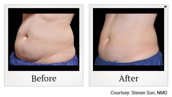Before and After Photo 11 of Coolsculpting® treatment at SF Bay Cosmetic Surgery Medical Group in San Ramon
