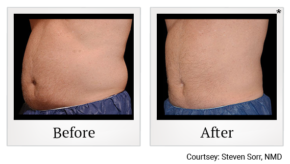 Before and After Photo 12 of Coolsculpting® treatment at SF Bay Cosmetic Surgery Medical Group in San Ramon