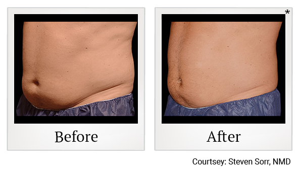 Before and After Photo 15 of Coolsculpting® treatment at SF Bay Cosmetic Surgery Medical Group in San Ramon