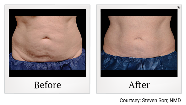 Before and After Photo 18 of Coolsculpting® treatment at SF Bay Cosmetic Surgery Medical Group in San Ramon