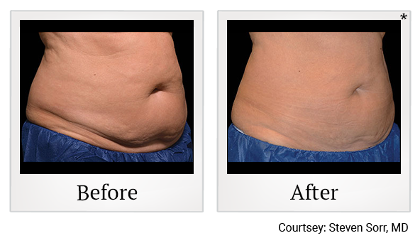 Before and After Photo 19 of Coolsculpting® treatment at SF Bay Cosmetic Surgery Medical Group in San Ramon