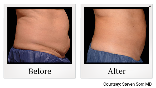 Before and After Photo 20 of Coolsculpting® treatment at SF Bay Cosmetic Surgery Medical Group in San Ramon