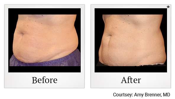 Before and After Photo 22 of Coolsculpting® treatment at SF Bay Cosmetic Surgery Medical Group in San Ramon