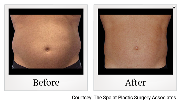 Before and After Photo 21 of Coolsculpting® treatment at SF Bay Cosmetic Surgery Medical Group in San Ramon
