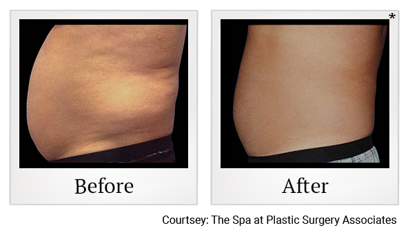 Before and After Photo 24 of Coolsculpting® treatment at SF Bay Cosmetic Surgery Medical Group in San Ramon