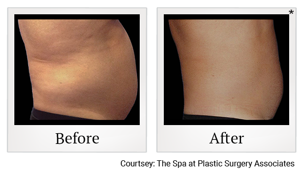 Before and After Photo 25 of Coolsculpting® treatment at SF Bay Cosmetic Surgery Medical Group in San Ramon
