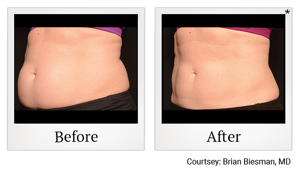 Before and After Photo 26 of Coolsculpting® treatment at SF Bay Cosmetic Surgery Medical Group in San Ramon