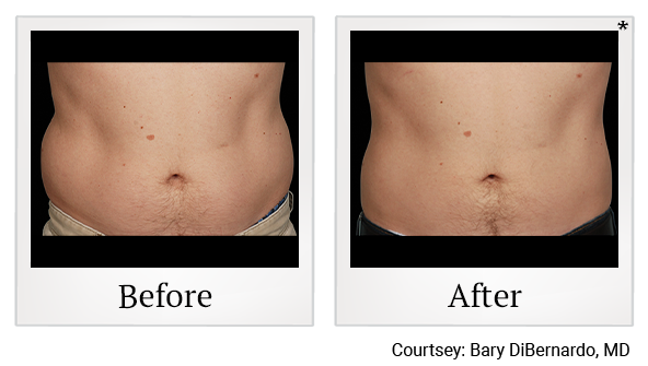 Before and After Photo 27 of Coolsculpting® treatment at SF Bay Cosmetic Surgery Medical Group in San Ramon
