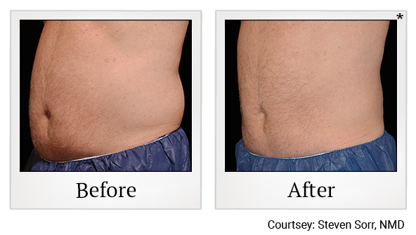 Before and After Photo 29 of Coolsculpting® treatment at SF Bay Cosmetic Surgery Medical Group in San Ramon