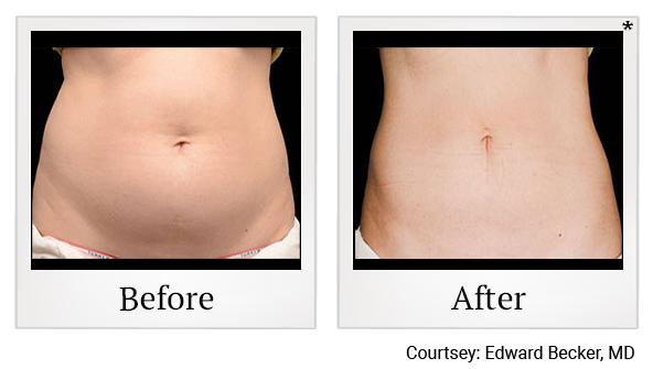 Before and After Photo 3 of Coolsculpting® treatment at SF Bay Cosmetic Surgery Medical Group in San Ramon