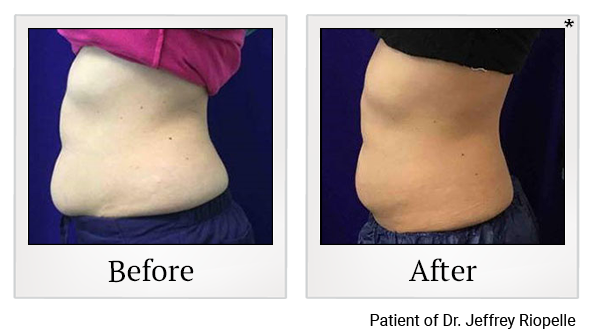 Before and After Photo 2 of Coolsculpting® treatment at SF Bay Cosmetic Surgery Medical Group in San Ramon, Pleasanton, San Jose, and Oakland