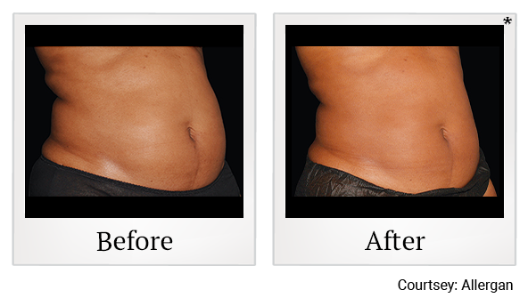 Before and After Photo 8 of Coolsculpting® treatment at SF Bay Cosmetic Surgery Medical Group in San Ramon