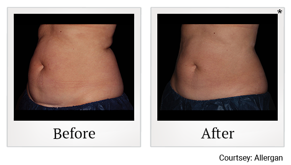 Before and After Photo 9 of Coolsculpting® treatment at SF Bay Cosmetic Surgery Medical Group in San Ramon