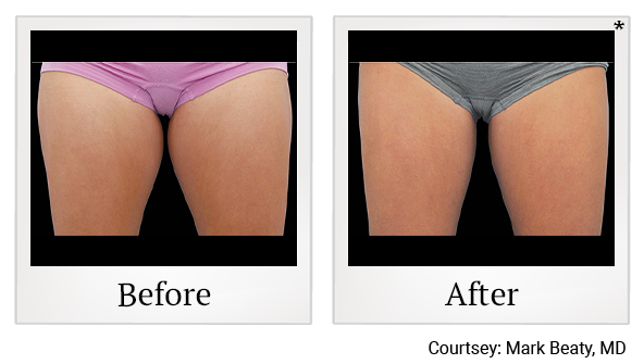 Before and After Photo 2 of Coolsculpting® treatment at SF Bay Cosmetic Surgery Medical Group in San Ramon