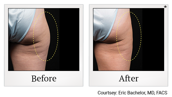 Before and After Photo 4 of Coolsculpting® treatment at SF Bay Cosmetic Surgery Medical Group in San Ramon