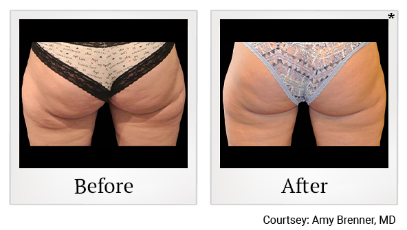 Before and After Photo 6 of Coolsculpting® treatment at SF Bay Cosmetic Surgery Medical Group in San Ramon