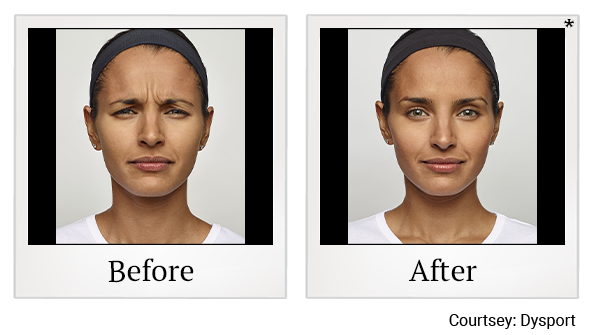 Before and After Photo 1 of Dysport® treatment at SF Bay Cosmetic Surgery Medical Group in San Ramon, Pleasanton, San Jose, and Oakland