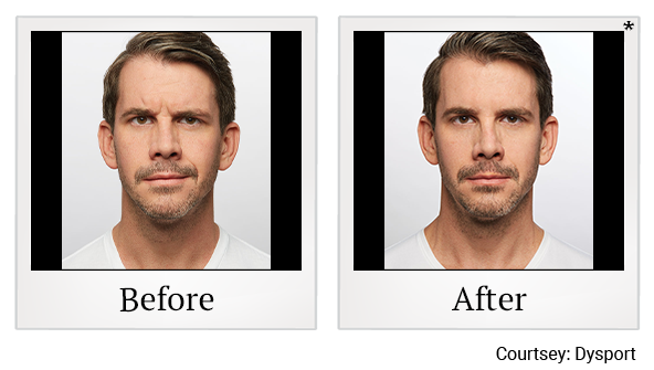 Before and After Photo 10 of Dysport® treatment at SF Bay Cosmetic Surgery Medical Group in San Ramon