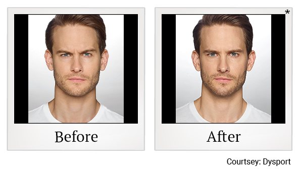 Before and After Photo 12 of Dysport® treatment at SF Bay Cosmetic Surgery Medical Group in San Ramon