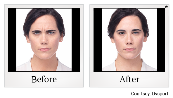 Before and After Photo 15 of Dysport® treatment at SF Bay Cosmetic Surgery Medical Group in San Ramon