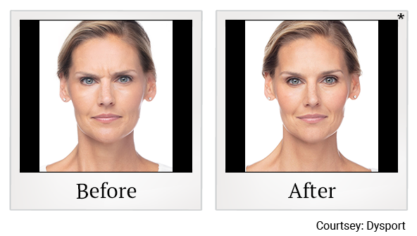 Before and After Photo 16 of Dysport® treatment at SF Bay Cosmetic Surgery Medical Group in San Ramon
