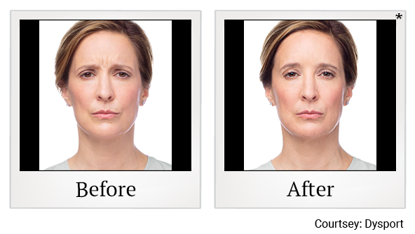 Before and After Photo 17 of Dysport® treatment at SF Bay Cosmetic Surgery Medical Group in San Ramon