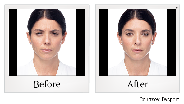 Before and After Photo 19 of Dysport® treatment at SF Bay Cosmetic Surgery Medical Group in San Ramon