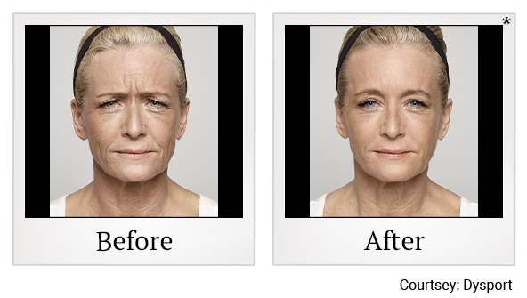 Before and After Photo 2 of Dysport® treatment at SF Bay Cosmetic Surgery Medical Group in San Ramon, Pleasanton, San Jose, and Oakland