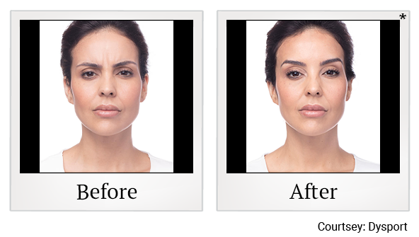 Before and After Photo 20 of Dysport® treatment at SF Bay Cosmetic Surgery Medical Group in San Ramon