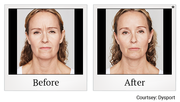 Before and After Photo 21 of Dysport® treatment at SF Bay Cosmetic Surgery Medical Group in San Ramon