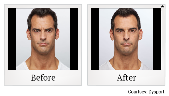 Before and After Photo 3 of Dysport® treatment at SF Bay Cosmetic Surgery Medical Group in San Ramon, Pleasanton, San Jose, and Oakland