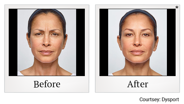 Before and After Photo 4 of Dysport® treatment at SF Bay Cosmetic Surgery Medical Group in San Ramon, Pleasanton, San Jose, and Oakland