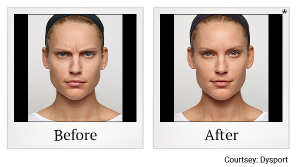 Before and After Photo 5 of Dysport® treatment at SF Bay Cosmetic Surgery Medical Group in San Ramon
