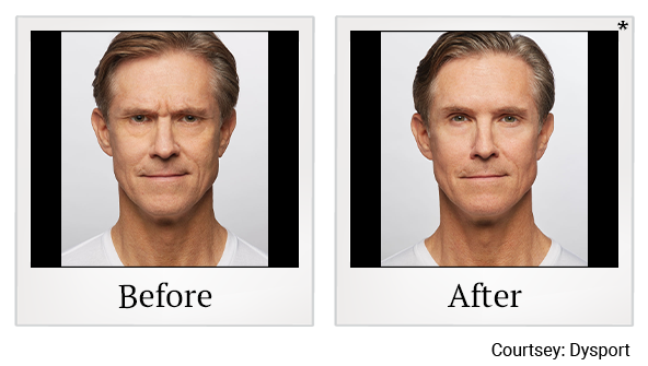 Before and After Photo 6 of Dysport® treatment at SF Bay Cosmetic Surgery Medical Group in San Ramon