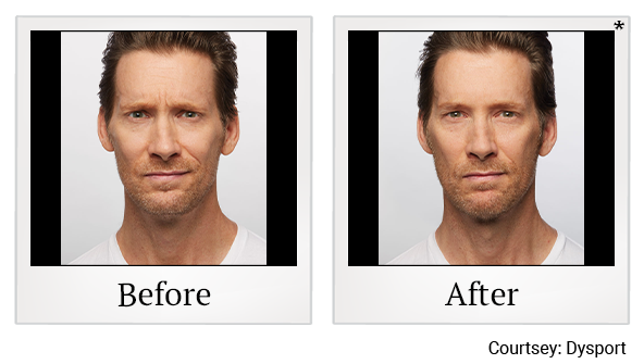 Before and After Photo 7 of Dysport® treatment at SF Bay Cosmetic Surgery Medical Group in San Ramon