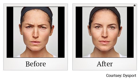 Before and After Photo 8 of Dysport® treatment at SF Bay Cosmetic Surgery Medical Group in San Ramon