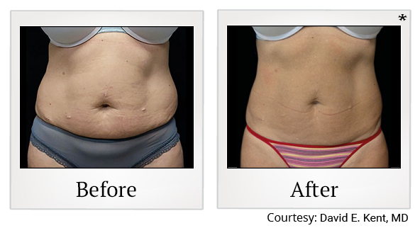 Before and After Photo 12 of Emsculpt® treatment at SF Bay Cosmetic Surgery Medical Group in San Ramon