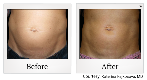 Before and After Photo 14 of Emsculpt® treatment at SF Bay Cosmetic Surgery Medical Group in San Ramon